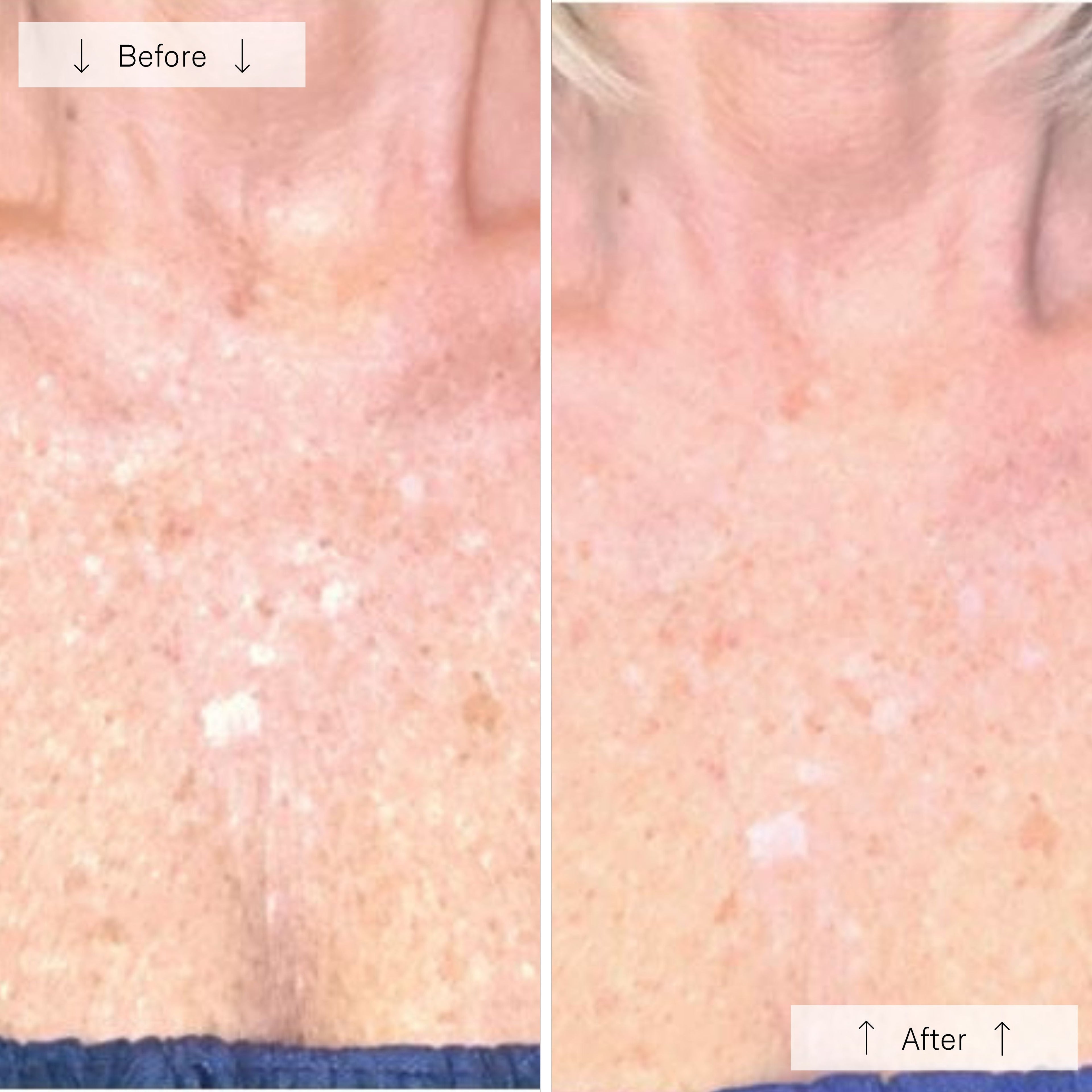 Omnilux Contour Neck & Décolleté